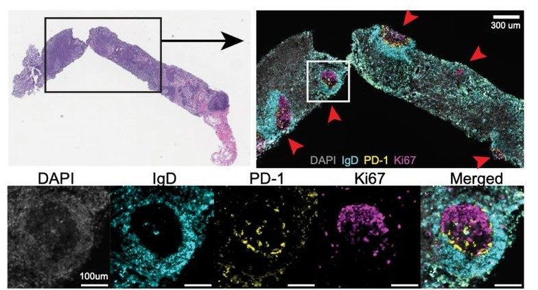 Immunofluorescence of germinal centers in a lymph node biopsy after hepatitis B vaccination